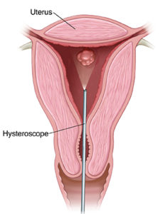 Hysteroscopy - Ashirwad Hospital Raipur