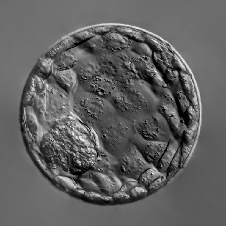 Blastocyst culture and transfer