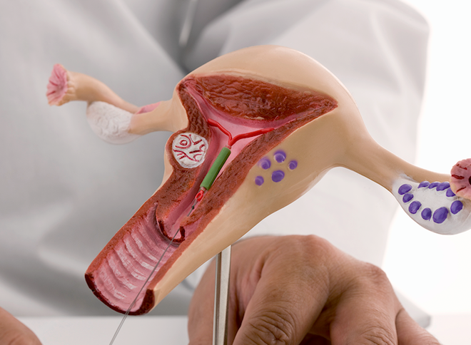 IUI - Ashirwad Hospital Raipur